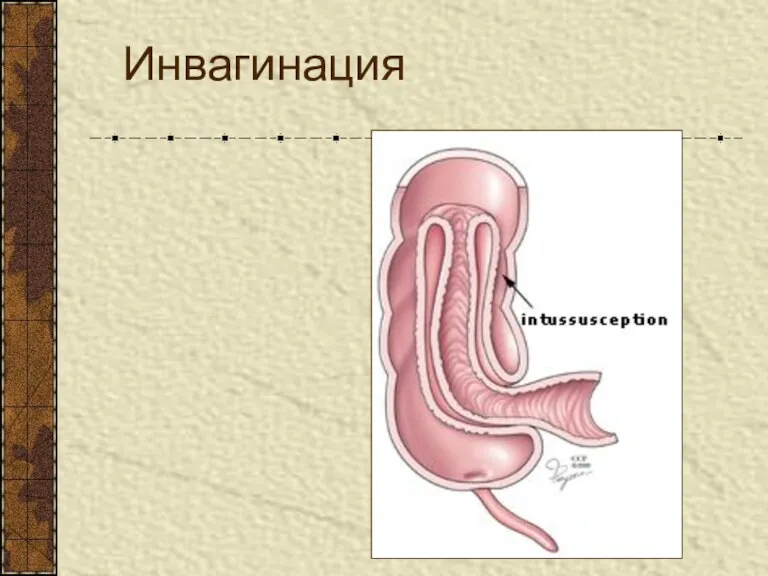 Инвагинация