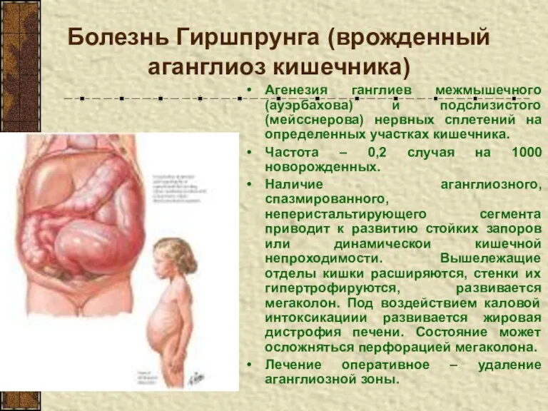 Болезнь Гиршпрунга (врожденный аганглиоз кишечника) Агенезия ганглиев межмышечного (ауэрбахова) и