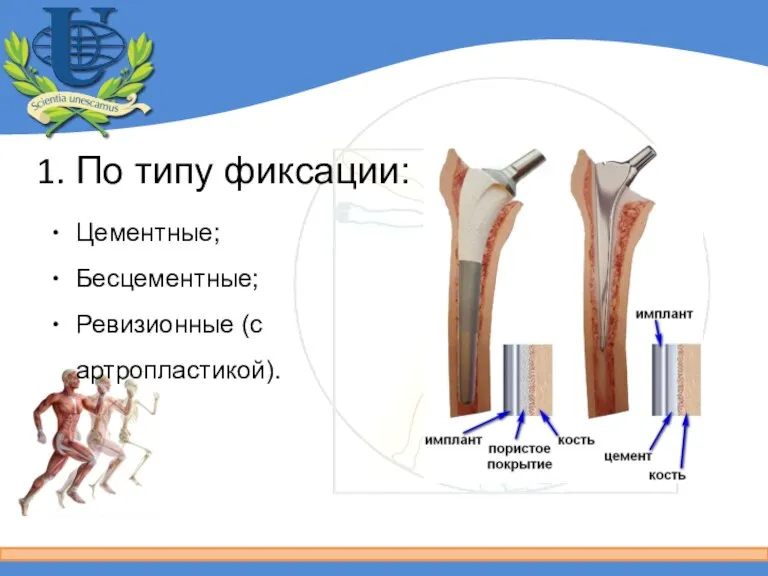 По типу фиксации: Цементные; Бесцементные; Ревизионные (с артропластикой).