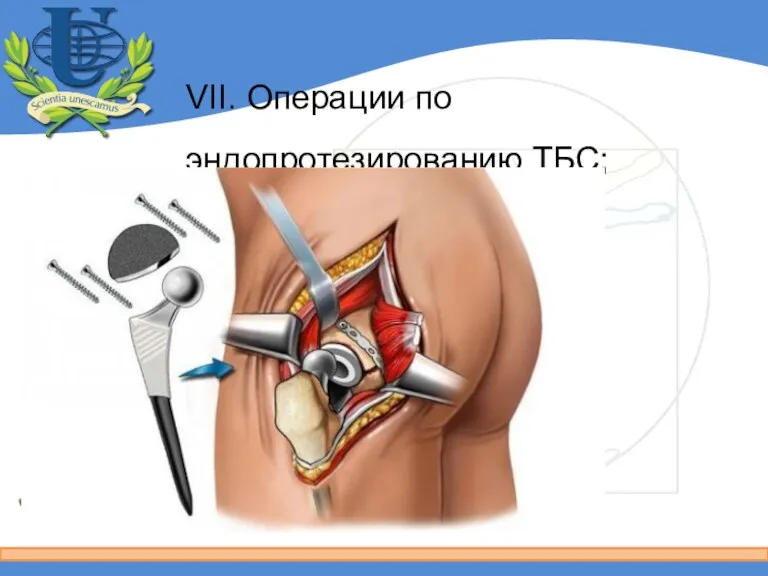 VII. Операции по эндопротезированию ТБС;