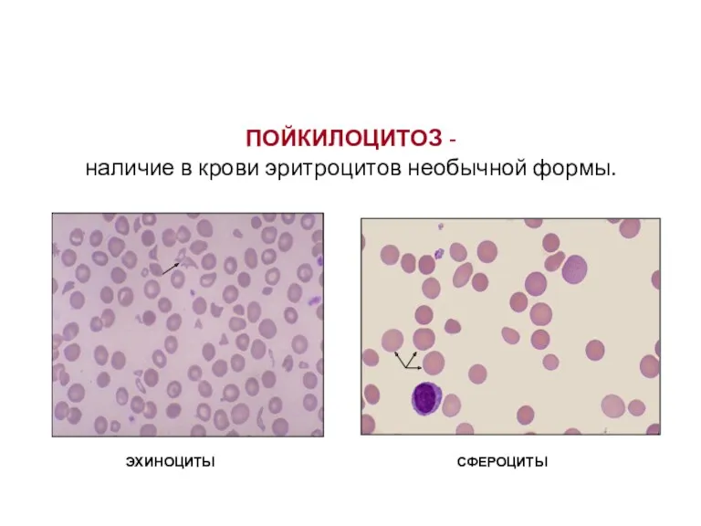 ПОЙКИЛОЦИТОЗ - наличие в крови эритроцитов необычной формы. эхиноциты сфероциты СФЕРОЦИТЫ ЭХИНОЦИТЫ