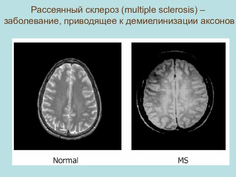 Рассеянный склероз (multiple sclerosis) – заболевание, приводящее к демиелинизации аксонов