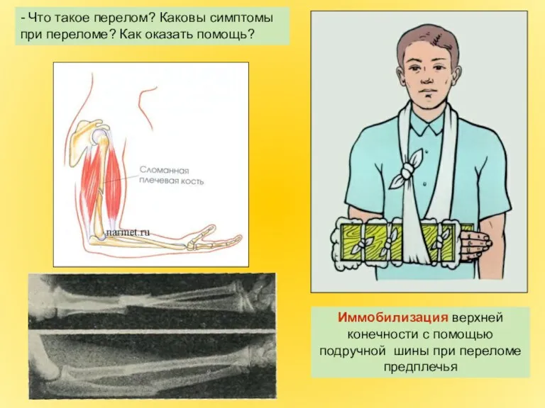 Иммобилизация верхней конечности с помощью подручной шины при переломе предплечья