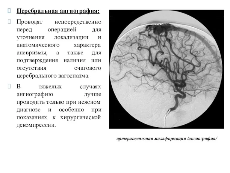 артериовенозная мальформация /ангиография/ Церебральная ангиография: Проводят непосредственно перед операцией для