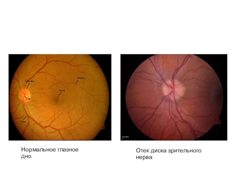 Нормальное глазное дно Отек диска зрительного нерва