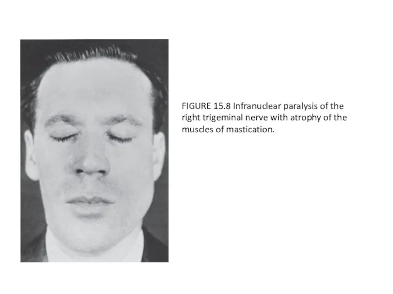 FIGURE 15.8 Infranuclear paralysis of the right trigeminal nerve with atrophy of the muscles of mastication.