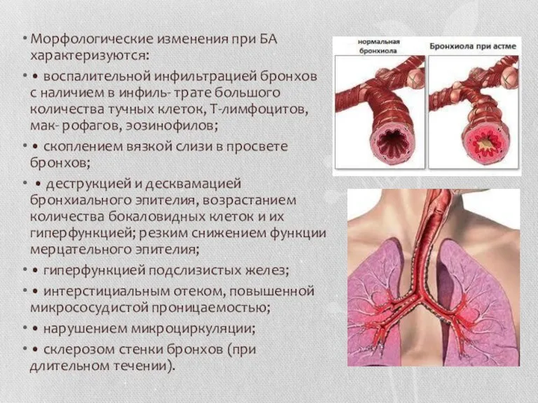 Морфологические изменения при БА характеризуются: • воспалительной инфильтрацией бронхов с