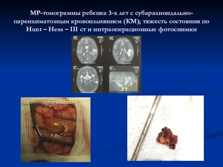 МР-томограммы ребенка 3-х лет с субарахноидально-паренхиматозным кровоизлиянием (КМ); тяжесть состояния
