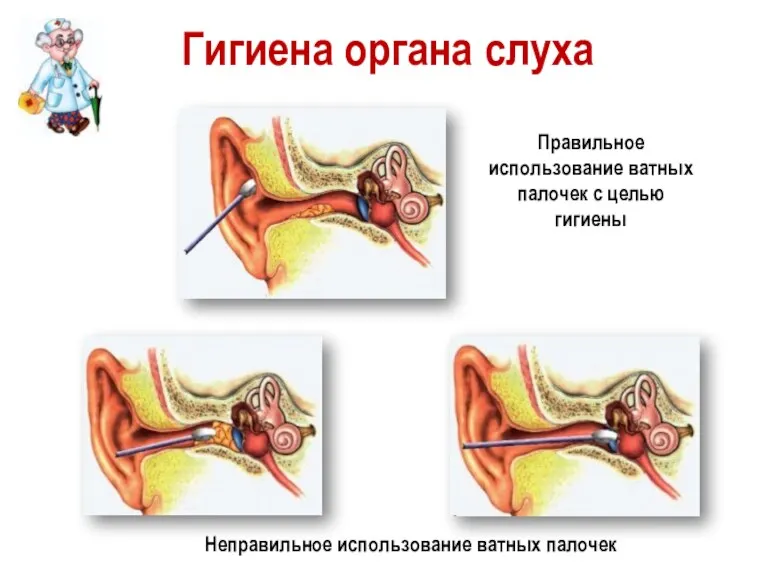 Гигиена органа слуха Правильное использование ватных палочек с целью гигиены Неправильное использование ватных палочек