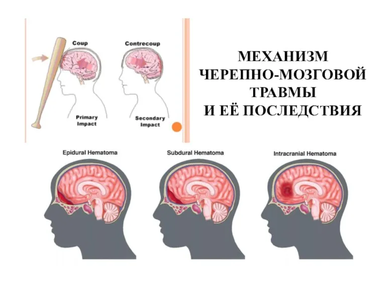 МЕХАНИЗМ ЧЕРЕПНО-МОЗГОВОЙ ТРАВМЫ И ЕЁ ПОСЛЕДСТВИЯ