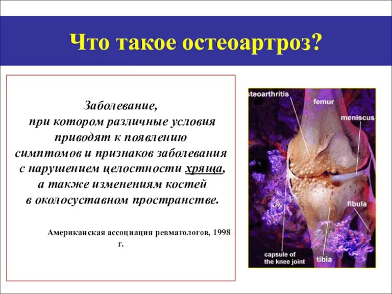 Что такое остеоартроз? Заболевание, при котором различные условия приводят к появлению симптомов и