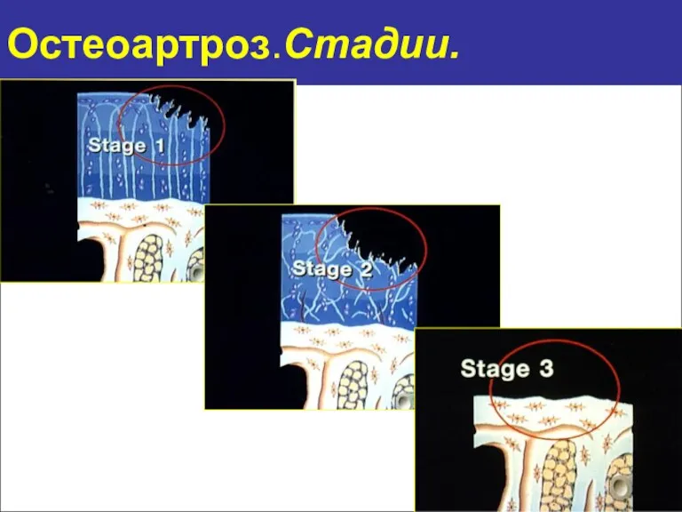 Остеоартроз.Стадии.