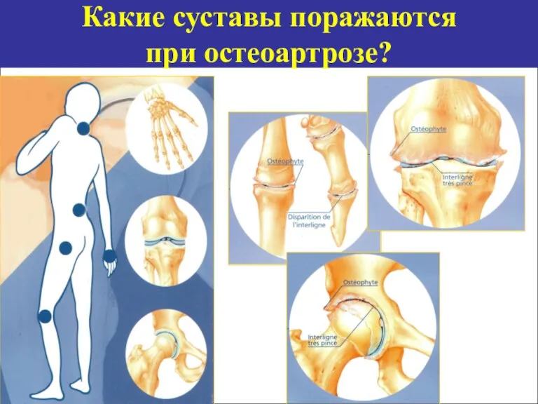 Какие суставы поражаются при остеоартрозе?