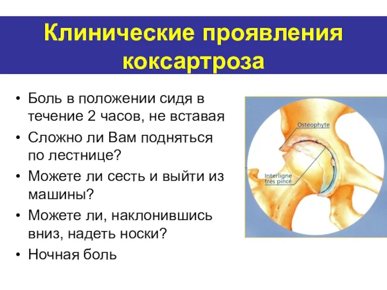 Клинические проявления коксартроза Боль в положении сидя в течение 2 часов, не вставая