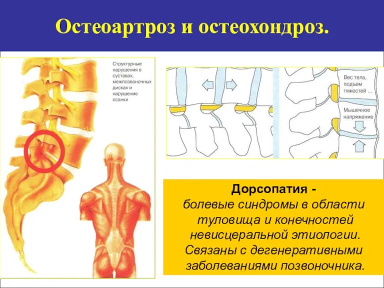 Остеоартроз и остеохондроз. Дорсопатия - болевые синдромы в области туловища и конечностей невисцеральной