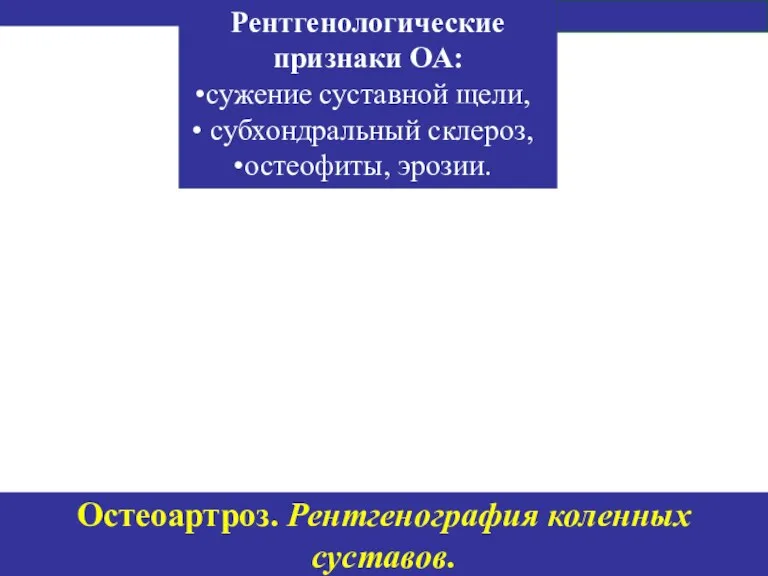 Остеоартроз. Рентгенография коленных суставов. Рентгенологические признаки ОА: сужение суставной щели, субхондральный склероз, остеофиты, эрозии.