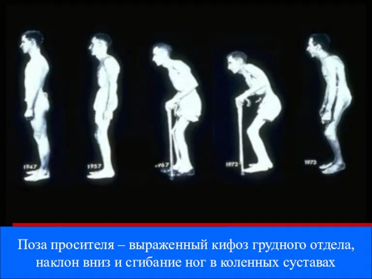 Поза просителя – выраженный кифоз грудного отдела, наклон вниз и сгибание ног в коленных суставах