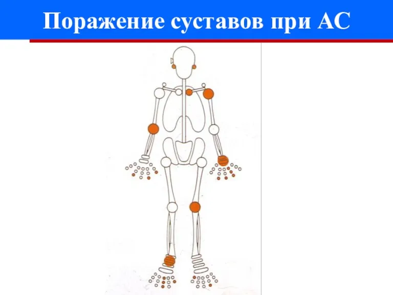 Поражение суставов при АС