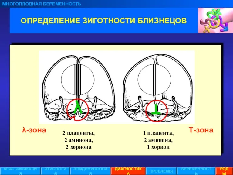 ОПРЕДЕЛЕНИЕ ЗИГОТНОСТИ БЛИЗНЕЦОВ МНОГОПЛОДНАЯ БЕРЕМЕННОСТЬ ЭТИОЛОГИЯ ЭПИДЕМИОЛОГИЯ ПРОБЛЕМЫ БЕРЕМЕННОСТЬ РОДЫ