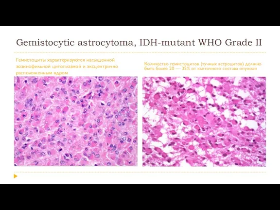Gemistocytic astrocytoma, IDH-mutant WHO Grade II Гемистоциты характеризуются насыщенной эозинофильной