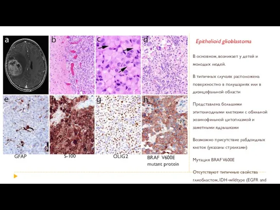 Epithelioid glioblastoma В основном, возникает у детей и молодых людей.