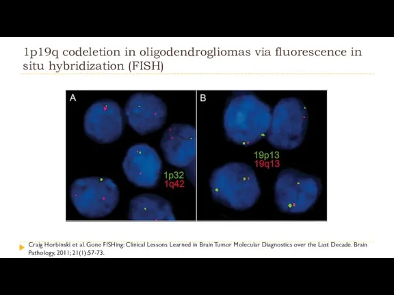 1p19q codeletion in oligodendrogliomas via fluorescence in situ hybridization (FISH)