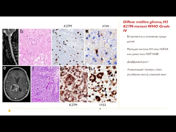 Diffuse midline glioma, H3 K27M-mutant WHO Grade IV Встречается, в