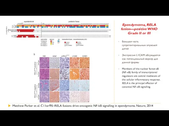 Ependymoma, RELA fusion—positive WHO Grade II or III Большая часть