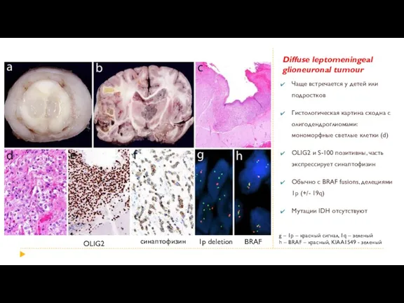 Diffuse leptomeningeal glioneuronal tumour Чаще встречается у детей или подростков