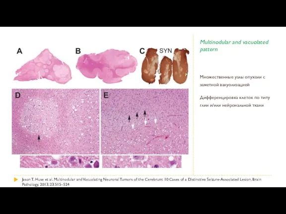 Multinodular and vacuolated pattern Множественные узлы опухоли с заметной вакуолизацией