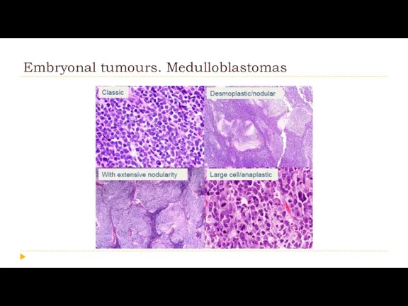 Embryonal tumours. Medulloblastomas