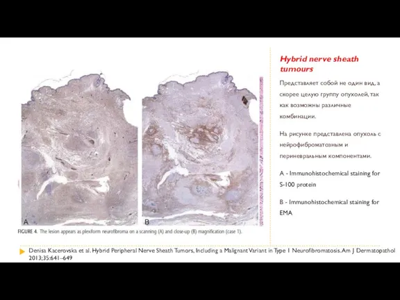 Hybrid nerve sheath tumours Представляет собой не один вид, а