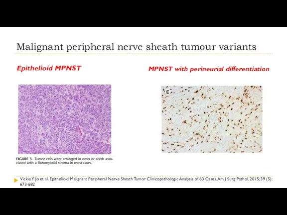 Malignant peripheral nerve sheath tumour variants Epithelioid MPNST MPNST with