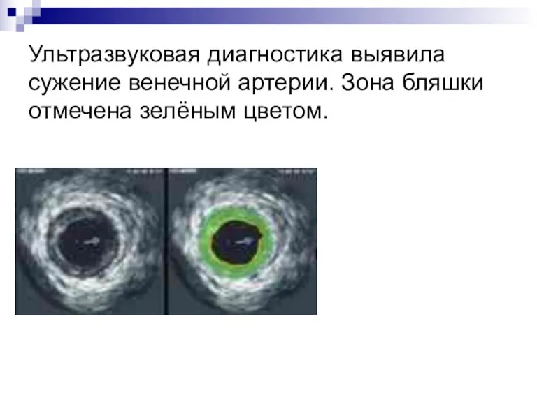 Ультразвуковая диагностика выявила сужение венечной артерии. Зона бляшки отмечена зелёным цветом.