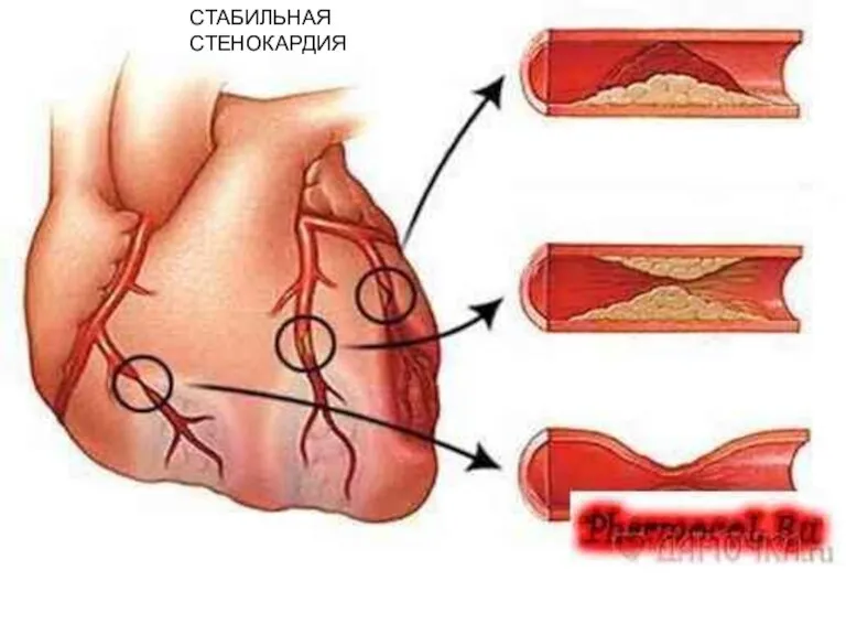 Стабильная стенокардия СТАБИЛЬНАЯ СТЕНОКАРДИЯ