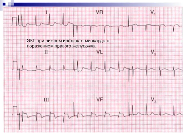 ЭКГ при нижнем инфаркте миокарда с поражением правого желудочка.