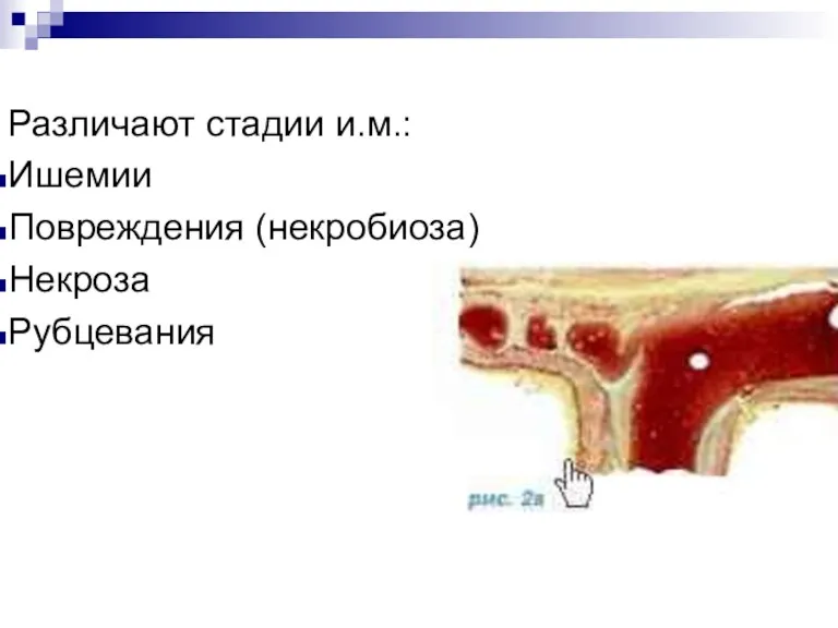 Различают стадии и.м.: Ишемии Повреждения (некробиоза) Некроза Рубцевания