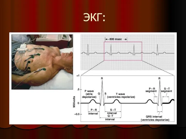 ЭКГ: