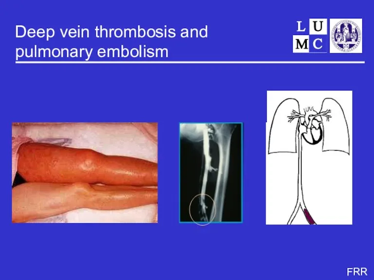 Deep vein thrombosis and pulmonary embolism