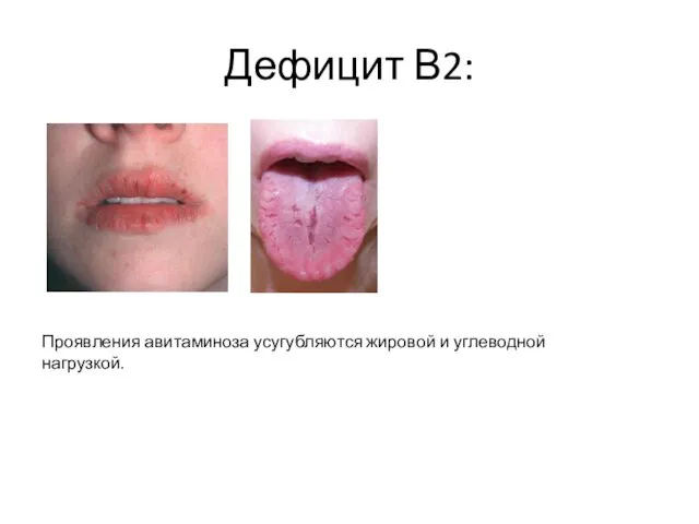 Дефицит В2: Проявления авитаминоза усугубляются жировой и углеводной нагрузкой.