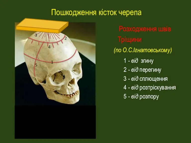 Пошкодження кісток черепа Розходження швів Тріщини (по О.С.Ігнатовському) 1 - від згину 2