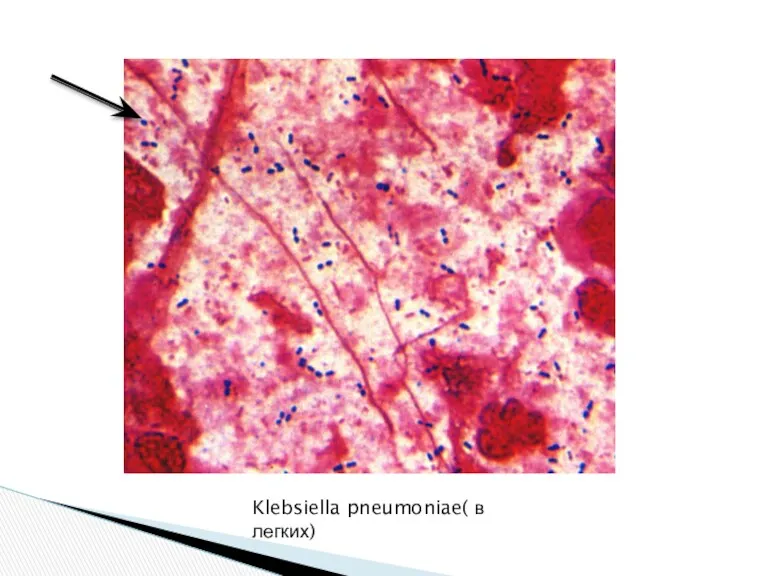 Klebsiella pneumoniae( в легких)