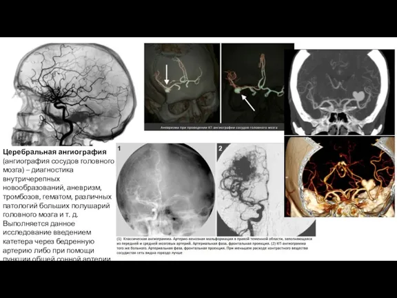 Церебральная ангиография (ангиография сосудов головного мозга) – диагностика внутричерепных новообразований, аневризм, тромбозов, гематом,