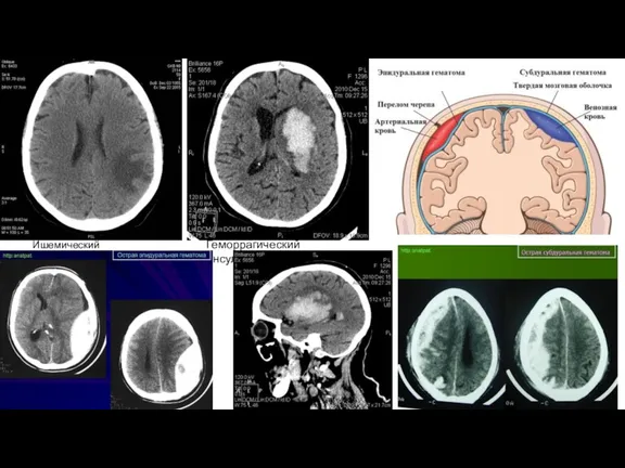 Ишемический инсульт Геморрагический инсульт