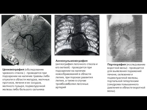 Целиакография (обследование чревного ствола ) - проводится при подозрении на наличие травмы либо