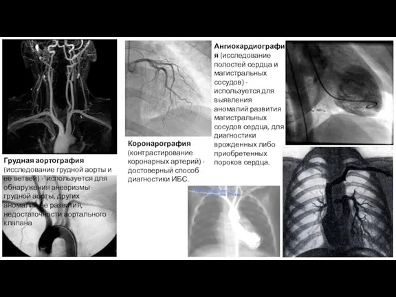 Грудная аортография (исследование грудной аорты и ее ветвей) - используется для обнаружения аневризмы