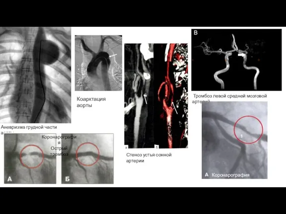 Аневризма грудной части аорты Коарктация аорты Стеноз устья сонной артерии Тромбоз левой средней