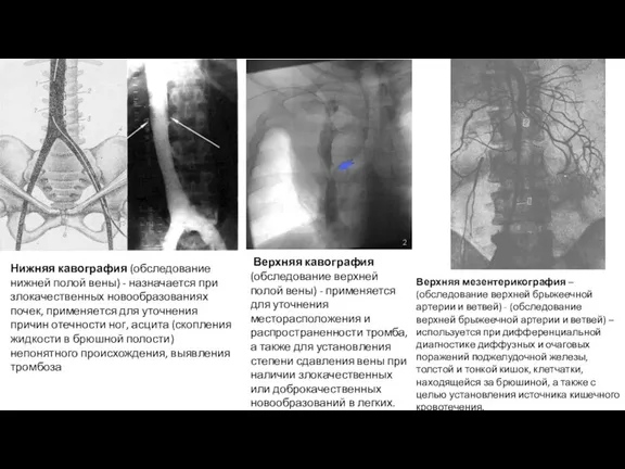 Нижняя кавография (обследование нижней полой вены) - назначается при злокачественных новообразованиях почек, применяется