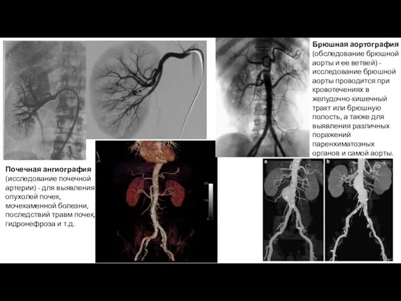 Почечная ангиография (исследование почечной артерии) - для выявления опухолей почек, мочекаменной болезни, последствий