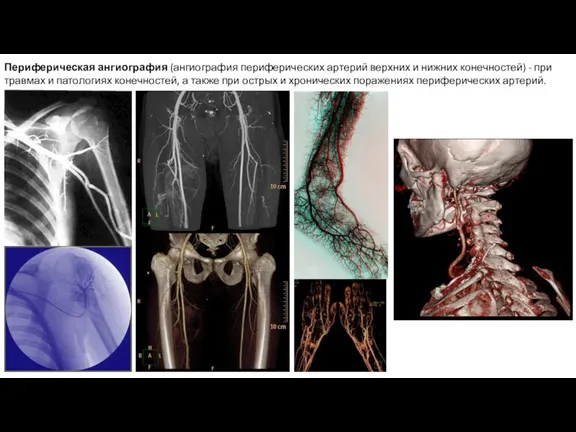 Периферическая ангиография (ангиография периферических артерий верхних и нижних конечностей) - при травмах и